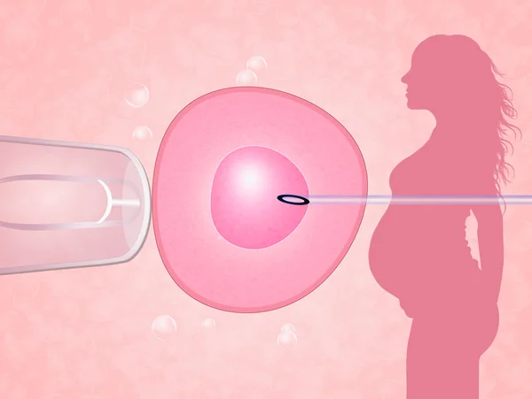 Is In Vitro Fertilization (IVF) Pregnancy High-Risk?