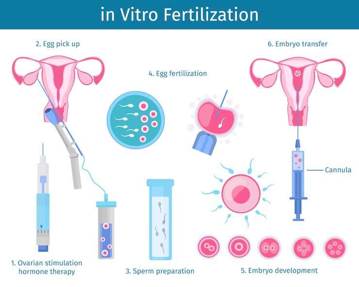IVF Cycle