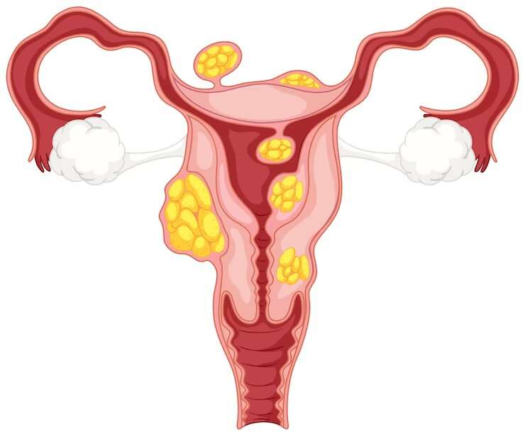 Endometriosis And Fertility: Reasons For Infertility In Women