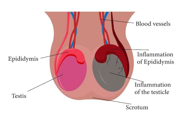 Epididymitis Treatment: You Need To Know Everything