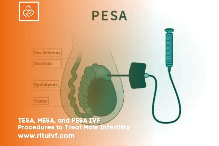 TESA, MESA, and PESA IVF Procedures to Treat Male Infertility 