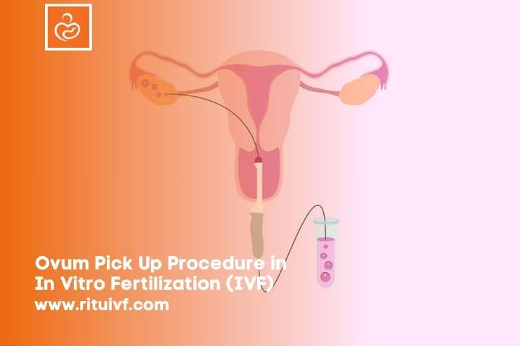 Ovum Pick Up Procedure in In Vitro Fertilization (IVF) 