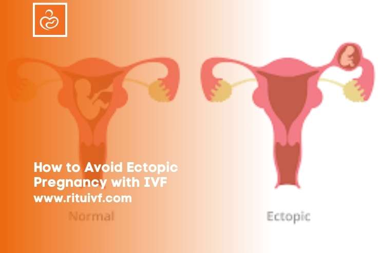 How to Avoid Ectopic Pregnancy with IVF When Getting Treated at the Best IVF Clinic?