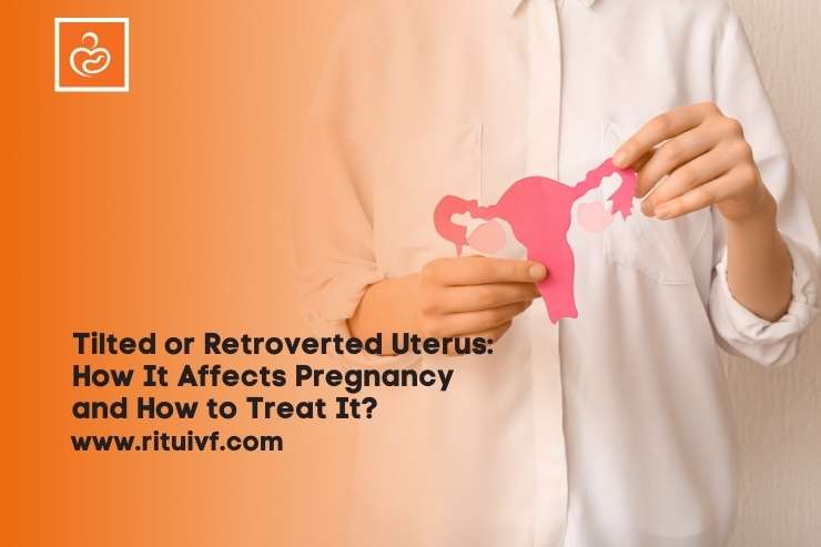 Tilted or Retroverted Uterus: How It Affects Pregnancy and How to Treat It?
