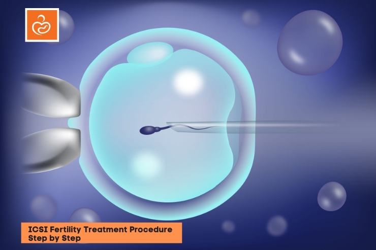 ICSI Fertility Treatment Procedure: Everything About Intracytoplasmic Sperm Injection Procedure 