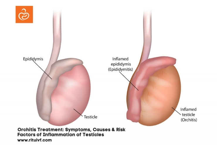 Orchitis Treatment: Symptoms, Causes & Risk Factors of Inflammation of Testicles